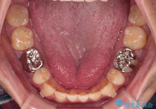 【モニター】舌のトレーニングを行いながら後戻りの再矯正の治療中