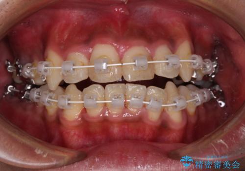 八重歯と開咬　ワイヤー装置での抜歯矯正の治療中