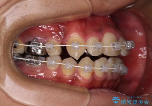 八重歯と開咬　ワイヤー装置での抜歯矯正の治療中