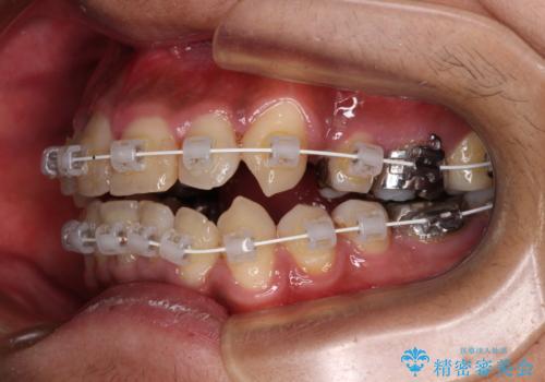 八重歯と開咬 ワイヤー装置での抜歯矯正の治療中