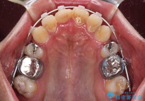 八重歯と開咬 ワイヤー装置での抜歯矯正の治療中