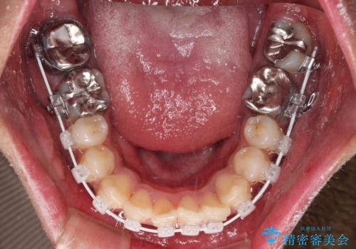 八重歯と開咬 ワイヤー装置での抜歯矯正の治療中