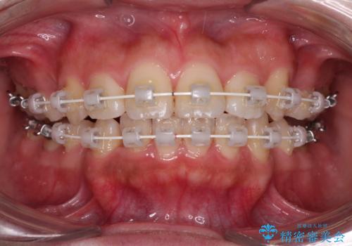 くちばしのような前歯が気になる　ワイヤー装置による抜歯矯正治療の治療中