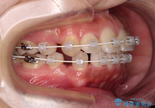 くちばしのような前歯が気になる ワイヤー装置による抜歯矯正治療の治療中