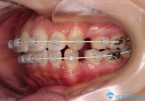 くちばしのような前歯が気になる ワイヤー装置による抜歯矯正治療の治療中