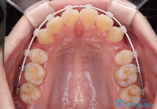 くちばしのような前歯が気になる　ワイヤー装置による抜歯矯正治療の治療中