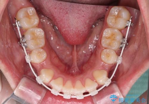くちばしのような前歯が気になる ワイヤー装置による抜歯矯正治療の治療中