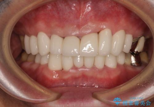 変色した前歯をきれいにしたい　部分矯正を併用した前歯の審美歯科治療の症例 治療後