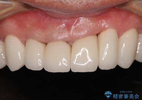 変色した前歯をきれいにしたい 部分矯正を併用した前歯の審美歯科治療の治療後