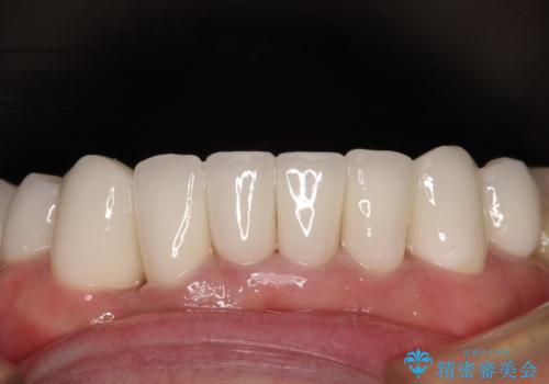変色した前歯をきれいにしたい 部分矯正を併用した前歯の審美歯科治療の治療後