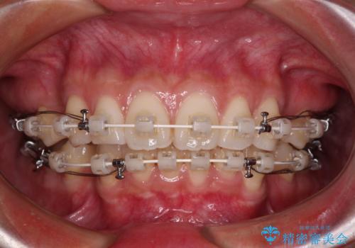 尖った前歯を引っ込めたい 目立たないワイヤー装置での抜歯矯正の治療中