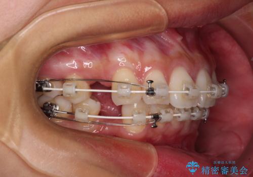 尖った前歯を引っ込めたい 目立たないワイヤー装置での抜歯矯正の治療中