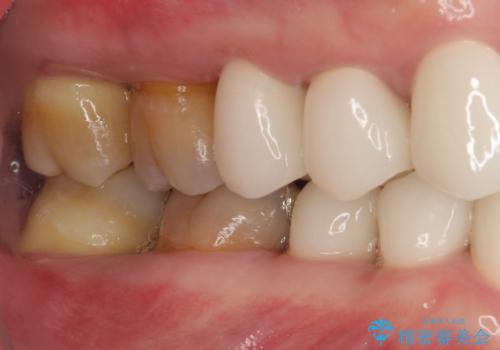 変色した前歯をきれいにしたい 部分矯正を併用した前歯の審美歯科治療の治療後