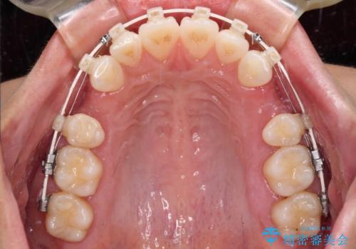 尖った前歯を引っ込めたい　目立たないワイヤー装置での抜歯矯正の治療中