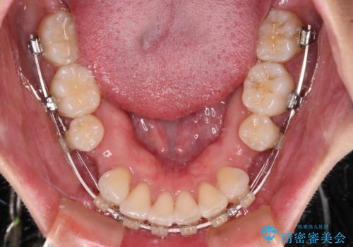 尖った前歯を引っ込めたい　目立たないワイヤー装置での抜歯矯正の治療中