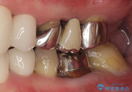 変色した前歯をきれいにしたい 部分矯正を併用した前歯の審美歯科治療の治療後