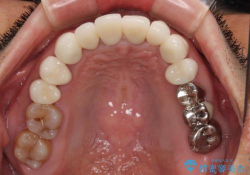 変色した前歯をきれいにしたい 部分矯正を併用した前歯の審美歯科治療の治療後