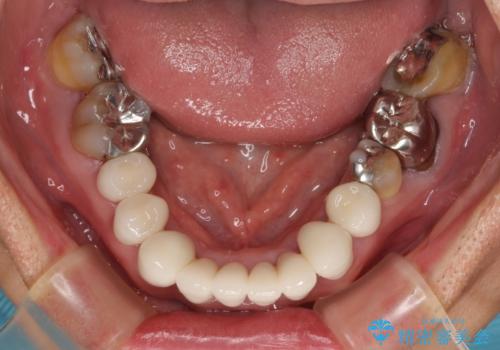 変色した前歯をきれいにしたい 部分矯正を併用した前歯の審美歯科治療の治療後