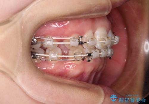 前歯のガタガタを整えたい　ワイヤー装置による抜歯矯正治療の治療中