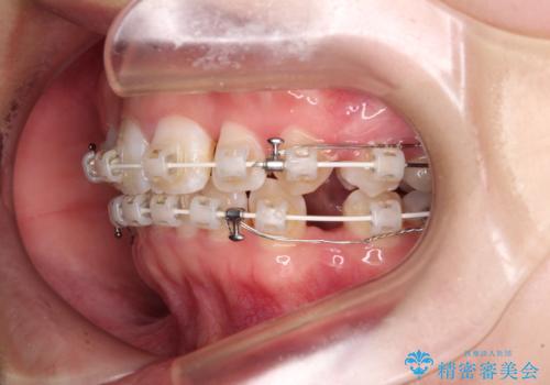 前歯のガタガタを整えたい　ワイヤー装置による抜歯矯正治療の治療中