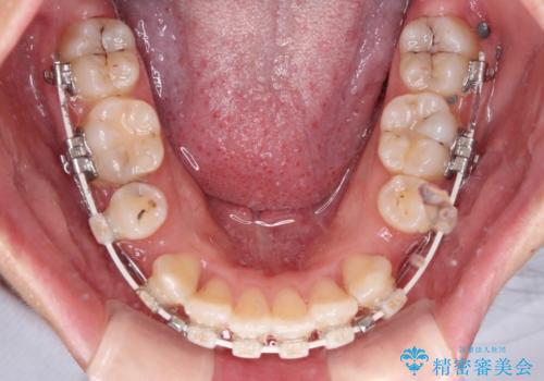 前歯のガタガタを整えたい ワイヤー装置による抜歯矯正治療の治療中