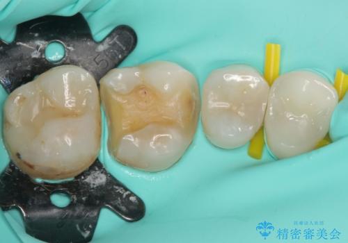 欠けてしまった奥歯 セラミッククラウンとセラミックインレーによるむし歯治療の治療中
