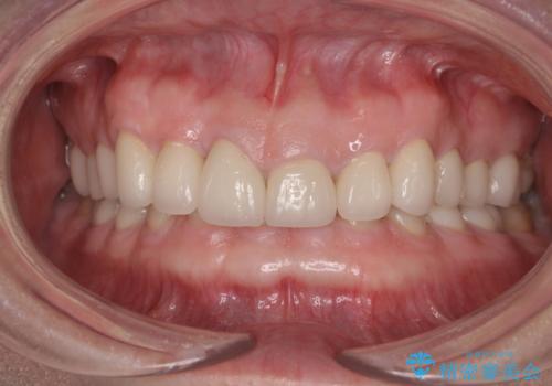 前歯の変色と隙間を治したい　前歯の審美歯科治療の症例 治療後