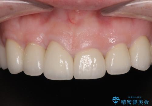 前歯の変色と隙間を治したい　前歯の審美歯科治療の治療後