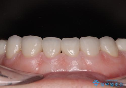 前歯の変色と隙間を治したい 前歯の審美歯科治療の治療後