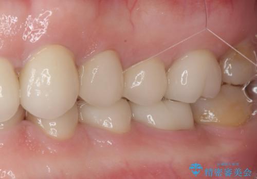 前歯の変色と隙間を治したい　前歯の審美歯科治療の治療後