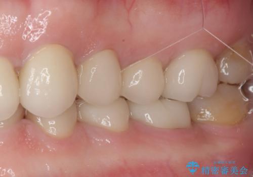 前歯の変色と隙間を治したい 前歯の審美歯科治療の治療後