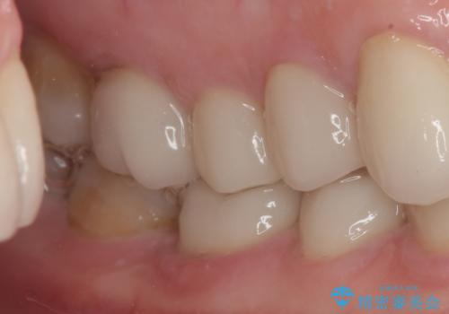 前歯の変色と隙間を治したい 前歯の審美歯科治療の治療後