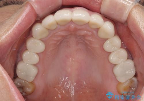 前歯の変色と隙間を治したい 前歯の審美歯科治療の治療後