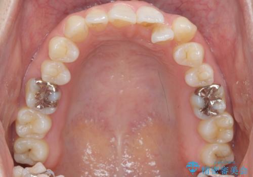 [ 歯並びと虫歯治療 ]  矯正治療とセラミック治療の包括治療の治療前