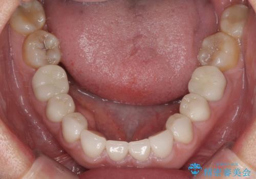 前歯の変色と隙間を治したい 前歯の審美歯科治療の治療後