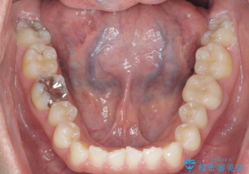 [ 歯並びと虫歯治療 ]  矯正治療とセラミック治療の包括治療の治療前