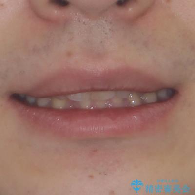 深い咬み合わせで顎が疲れる ワイヤー矯正でディープバイトを解消の治療前(顔貌)