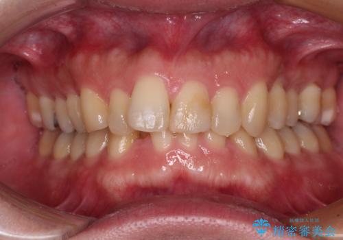 深い咬み合わせで顎が疲れる ワイヤー矯正でディープバイトを解消の症例 治療前