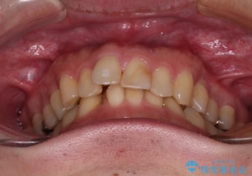 深い咬み合わせで顎が疲れる ワイヤー矯正でディープバイトを解消の治療前