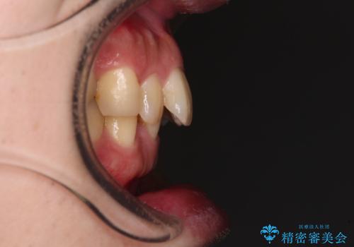 深い咬み合わせで顎が疲れる ワイヤー矯正でディープバイトを解消の治療前