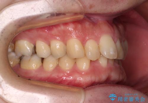 深い咬み合わせで顎が疲れる ワイヤー矯正でディープバイトを解消の治療前