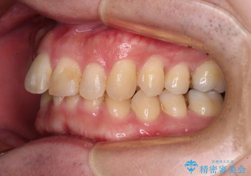 深い咬み合わせで顎が疲れる ワイヤー矯正でディープバイトを解消の治療前