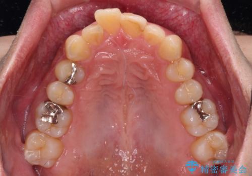 深い咬み合わせで顎が疲れる ワイヤー矯正でディープバイトを解消の治療前