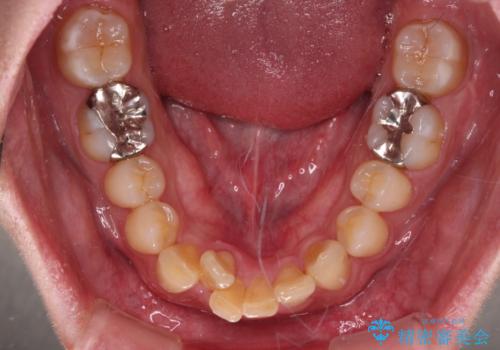 深い咬み合わせで顎が疲れる ワイヤー矯正でディープバイトを解消の治療前