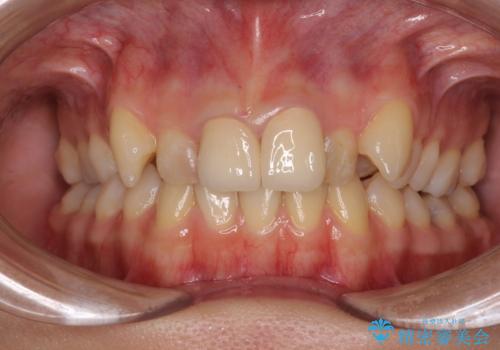 変色したバランスの悪い前歯をオールセラミッククラウンで自然な口元にの治療後