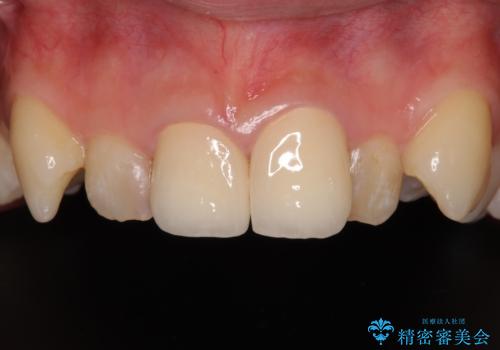 変色したバランスの悪い前歯をオールセラミッククラウンで自然な口元にの症例 治療後