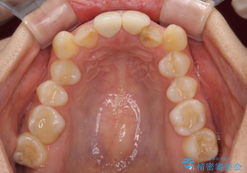 変色したバランスの悪い前歯をオールセラミッククラウンで自然な口元にの治療後