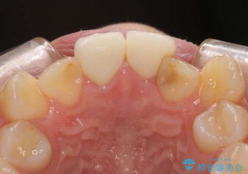 変色したバランスの悪い前歯をオールセラミッククラウンで自然な口元にの治療後