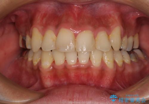 八重歯と開咬　ワイヤー装置での抜歯矯正の治療後