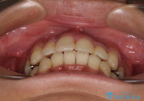 八重歯と開咬 ワイヤー装置での抜歯矯正の治療後